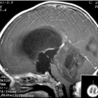 Fig. 3. A. IRM sagital que muestra meduloblastoma en el preoperatorio.