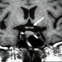 Fig 4. IRM postoperatoria. Se aprecia la glándula hipófisis y el quiasma óptico sin persistencia tumoral (flecha).