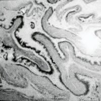Fig. 3. Preparado (H & E) que muestra el epitelio anterior intraespinal.	con melanina.
