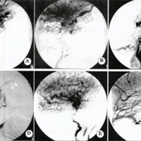 Fig. 19. Angiografía Digital de tratamiento de FDC en vista lateral derecha