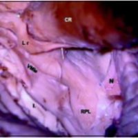 Fig. 14. Se comenzó a disecar el pedúnculo del flóculo y el nervio coclear. CR: cuerpo restiforme. Nc: nervio coclear. Pf: pedúnculo del flóculo. VMIe: porción estrecha (peduncular) del velo medular inferior uniéndose al pedúnculo del flóculo. Lr: labio rómbico, que se continúa con la tenia coroidea al tomar contacto con el cuerpo restiforme. La porción ancha del velo está incidida y replegada para ver RPL: receso posterolateral.