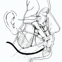 Fig. 1. Esquema descriptivo de la técnica de Sawamura. En blanco: nervio facial. En grin: nervio hipogloso.