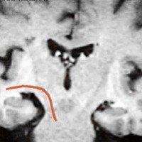 Fig. 12: corte coronal del encéfalo que muestra la porción sublenticular de la cápsula interna. La línea roja representa las fibras témporo pontinas.