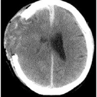 Fig. 7. TAC de cerebro. Craniectomía descompresiva en paciente con TEC. No se realizó cierre dural. Herniación del tejido cerebral a través del defecto dural.
