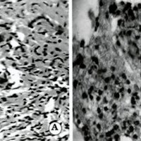Fig. 3. A. Corte histológico, técnica H-E. donde se evidencia tejido fibroso, esclerohialino infiltrado por elementos inflamatorios heterogéneos constituidos por linfocitos, plasmocitos y macrófagos. B. Corte histológico, inmunomarcación específica para linfocitos 