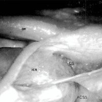 Fig. 1: Vista póstero-lateral del Espacio Clinoideo ( CS ) y Espacio Anterior del Seno Cavernoso ( ACSS ), Arteria Carótida Interna (ica) en su segmento clinoídeo y cavernoso, Nervio Optico ( on ) destechado.<br />
