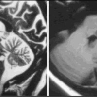 Fig. 5. Caso 2: cavernoma en proyección del pedúnculo cerebeloso medio izquierdo.