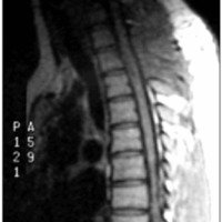 Fig. 4. IRM sagital de columna dorsal ponderada en T1 que muestra la reducción de la cavidad siringomiélica luego de una derivación siringopleural.