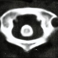 Fig. 2. TAC C I -C2: luxación anterior C I -C2 con preservación odontoidea.