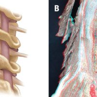 Figura 5: A: Osteotomía grado 4. B: Fotografía 3D de la Osteotomía grado 4.