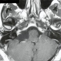 Fig. 2. IRM en secuencia T1 con gadolinio donde se evidenciaron cambios postquirúrgicos en el ángulo pontocerebeloso derecho sin evidencia de lesión tumoral.