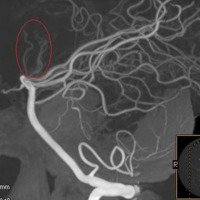 Figura 2: A) Arterias Interpedunculares Cortas en corte mediosagital tomográfico de Angiografía – CENBA.2013, B): Arterias Diencefálicas en corte parasagital tomográfico de Angiografía – CENBA 2013., C) Arterias Mesencefálicas en corte parasagital tomográfico de Angiografía – CENBA 2013.