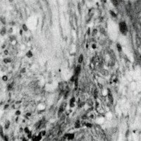 Figura 5. Inmunomarcación Proteína S-100: Se demuestra la positividad del tumor ante este anti-suero. Método Peroxidasa Anti-perosidasa. Obj. x 10.