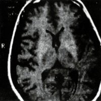Fig. 6. RMN de control a dos meses del debut clinico.