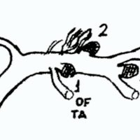 Figura 1: Ubicación de los aneurismas silvianos. 1) Origen de rama precoz. 2) Origen de lentículo estriada. 3) Bifurcación. 4) Distales. Se denominó escalonados a dos aneurismas que nacían del mismo vaso, en el origen de dos ramas consecutivas.<br />
