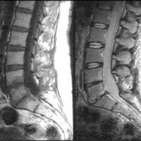 Fig. 4. Imagen a 16 semanas del postoperatorio. Resolución casi total del proceso osteomielítico