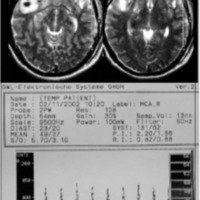 Fig. 6. IRM con contusiones hemorrágicas bilaterales y DTC que muestra signos sonográficos de hipertensión endocraneana.
