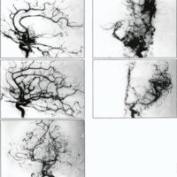 Fig. 3. Estenosis carotídea bilateral en segmento supra clinoideo y desarrollo de red vascular prfunda. Sector posterior indemne. A y B. <br />
Angiografía carotídea derecha en incidencia lateral y ántero posterior. C y D. Angiografia carotídea izquierda en incidencia lateral y áptero-posterior. E. Sector posterior.<br />
