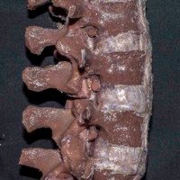 Figura 10: Vista lateral derecha. Osteotomía de Grado 2. Resección completa de ambas facetas articulares. El ligamento amarillo debe ser removido antes del cierre de la osteotomía.
