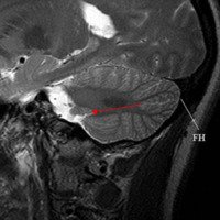 Figura 6: RMN de encéfalo. Corte sagital paramediano. La FH es la fisura más profunda en la cara suboccipital del cerebelo. El  núcleo dentado se encuentra por encima de la proyección de la FH (flecha roja).