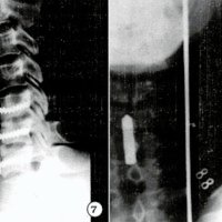 Fig. 7. Artrodesis metálica a 3 niveles; incurvación posterior del tomillo superior e inferior dentro del cuerpo vertebral. Fig. 8. Control P.O. inmediato