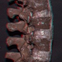 Figura 4: Vista lateral derecha. Osteotomía de grado 2. Se observa la relación estrecha entre la raíz nerviosa en el neuroforamen con la pars interarticularis, por detrás y arriba, y la faceta ascendente, por detrás y abajo.