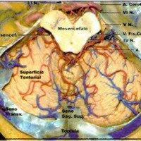 Fig. 6. Arteria cerebelosa superior y su relación con la fisura cerebelomesencefalica.