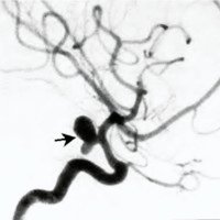 Fig. 2. Angiografia carotídea derecha en incidencia late rol, donde se observa un aneurisma comunicante poste rior (flecha), nótese la ausencia de opacificación de la arteria comunicante posterior debido a hipoplasia.<br />
