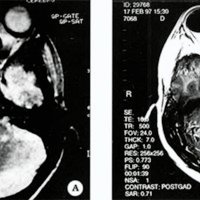 Fig. 3. Paciente sexo masculino de 15 años de edad, IRM: secuencia T1- cortes sagitales, A, Preoperatoriamente se visualiza una tumoración extraaxial en el piso de lujosa media. B, IRM postoperatorla sin restos tumorales.