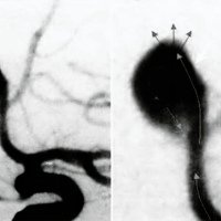 Fig. 7. Angiografía digital magnificada izquierda en proyección oblicua representando la dirección del flujo intraaneurismático, el punto de ruptura ele-chas chicas) y la disección de la pared aneurismática (flecha grande).<br />
