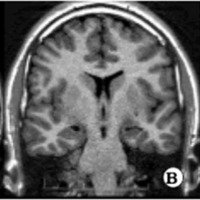 Fig. 13. Imágenes coronales en un paciente con diagnóstico de ETM. A. T2, B. IR, C. FLAIR. Se observa el hipocampo izquierdo de menor tamaño, con alteración en la estructura interna e hiperintenso en T2 y FLAIR. (Fundación Científica del Sur)