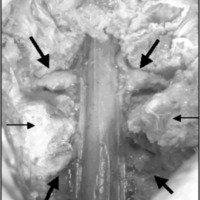 Fig. 1. Imagen cadavérica que muestra la remoción de las apófisis articulares y la visualización de los pedículos (flechas finas) y las raíces supra e infrayacentes al mismo (flechas gruesas).