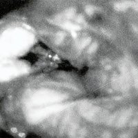 Fig. 6. Fotografía intraoperatoria: lesión cavernosa resecada totalmente.