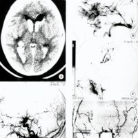 Fig. 1. Paciente de 7 años de edad que bruscamente presenta cefaleas y alteración de la conciencia.
