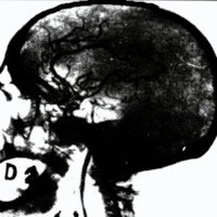 Fig. 11. Angiografia carotídea en incidencia lateral . El diagnóstico de los tumores cerebrales y pruebas de la encefalografia. arterial (Egas Moniz, 1931)