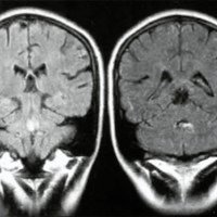 Fig. 3. IRM: imagen en piso de IV ventrículo hiperintensa en T1 que refuerza con gadolinio. compatible con metástasis.
