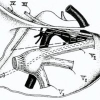 Fig. 9: Esquema en vista lateral de la zona de abordaje al seno cavernoso según Parkinson: el acceso por el triángulo marcado permite llegar a la carótida intracavernosa preservando los pares oculomotores y el nervio trigémino,