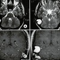 Fig. 3. Tomografia de cerebro con ventana ósea preoperatoria. A y B. Cortes axiales. C y D. Cortes coronales. Se observa esclerosis ósea de la región mastoidea derecha, con remodelación ósea y pérdida de las celdillas aéreas. La cavidad timpánica se encuentra libre.
