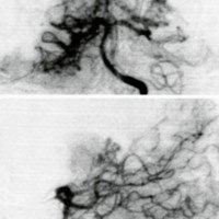 Fig. 2. Angiografía vertebral preoperatoria que muestra una MAV talámica posterior, alimentada por ramas de la cerebral posterior y drenaje a la vena basal.