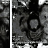 Fig. 4. 2002, IRM bajo tratamiento corticoide.