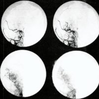 Fig. 1. Angiografia: reducción de la carótida internal derecha