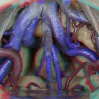 Figura 12: Se amplifica lo antes mencionado. Pueden distinguirse las venas vermiana superior, cerebrales internas, occipitales internas y segmento P3 de la arteria cerebral posterior. Detrás de las estructuras vasculares se descubre la glándula pineal, pulvinar del tálamo y por debajo los colículos superiores.