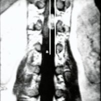 Fig, 2, Caso n° 3, IRM frontal ponderada en T1 que muestra el área de exposición inicial que queda entre la línea media (a) y el borde externo (b) de la hemilaminectomia.