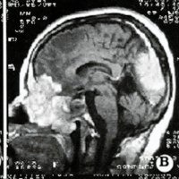 Estesioneuroblastoma con Metástasis Leptomeningeas a Distancia.<br /><br />
Reporte de un Caso y Revisión de la Literatura