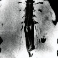 Fig. 5. IMR, corte coronas en T 1 de un caso de Diastema tomielia. Se observa la división de la médula espinal en dos hemimédulas y el tabique que las separa.