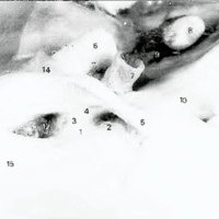 Fig. 5. Vista de la porción clinoidea de la arteria carótida luego de resecar la clinoides anterior, 