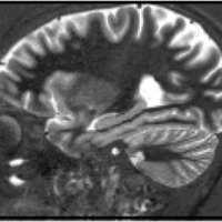 Fig. 12. Sagital T2 de 3 mm. Corte que pasa por la formación hipocampal. (Fundación Científica del Sur)
