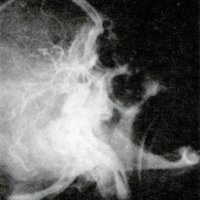 Figura 1a (Caso No. 1): Angiografía preoperatoria con shunt arterioven oso por FCC.