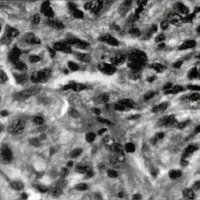 Fig. 9. Caso 7. Glioblastoma