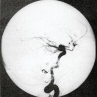 Figura 2E. Angiografía selectiva de la arteria vertebral izquierda, post-operatoria, en proyección de frente, que demuestra la oclusión de la fístula y la desaparición de la várice venosa.